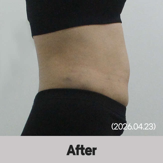 다이어트약+쉬다주사(Body) 시술 후